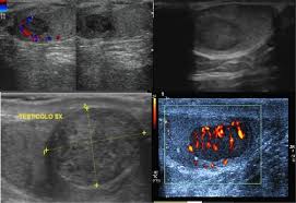 Il tumore del testicolo è la crescita anomala e incontrollata di cellule in uno o entrambi i testicoli. Tumori Testicolari Clinica E Diagnostica Siams