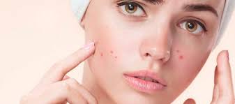 Akne Sivilce Nedenleri Ve Tedavisi Dermatoloji Ozel Rumeli Hastanesi