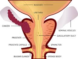 One major reason is the focus on. Prostate Cancer Awareness Month 6 Symptoms That May Mean Advanced Prostate Cancer Cancer 30seconds Health