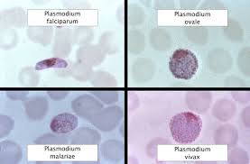 Home » difference between » 40 differences between plasmodium vivax and plasmodium falciparum. Malaria Amboss