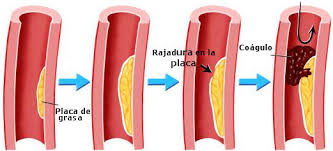 Resultado de imagen de imagenes de infarto agudo de miocardio etiologia