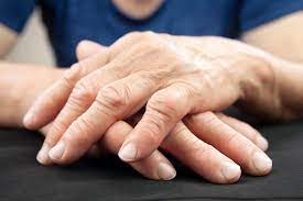This is just a mnemonic post on ra deformities. Risk Of Hand Deformity In Rheumatoid Arthritis