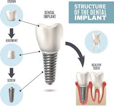 Image result for dental implant
