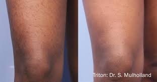 We can safely and effectively treat any skin type; The Best Laser Hair Removal In Newnan And Metro Atlanta