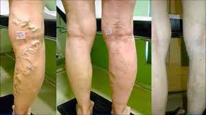 Como Desaparecer Las Varices Naturalmente