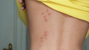 Image result for bedbugs bites