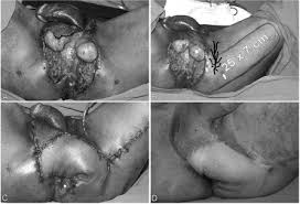 Modified Pudendal Thigh Flap For Perineoscrotal Reconstruction A Case Of Leriche Syndrome With Rapidly Progressing Fournier S Gangrene Urology