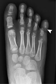 Image result for Interphalangeal Dislocation