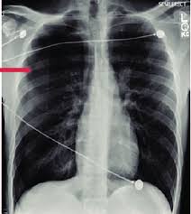 What is it?a pneumothorax is commonly known as a collapsed lung. Chest Roentgenogram On Admission Consistent With Right Pneumothorax Download Scientific Diagram