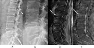 Image result for Spinal Infection