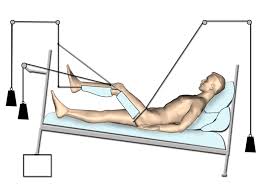 Buck's skin traction is widely used in the lower limb for femoral fractures, lower backache, acetabular and hip fractures. Skin Traction And Skeletal Traction Bone And Spine