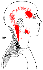 47 Prototypic Travell Trigger Point Chart