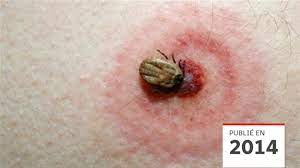 De mettre à jour sa protection vaccinale en effectuant ses rappels de vaccins, Maladie De Lyme Sous Diagnostiquee Ou Crainte Irrationnelle Radio Canada Ca