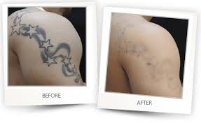 Best tattoo removal laser machines are for experts and for beginners in this niche to handle the tattoo removal process in an easy way. How To Remove A Tattoo Tattoo Removal Before And After Photos