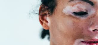 Formen und Behandlungsmethoden der Vitiligo