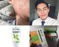 Dengan rajin mencuci muka, bermacam masalah wajah dapat dicegah. Kecewa Dengan Kulit Muka Jejaka Ini Kongsi Produk Atasi Masalah Breakout Pesona Pengantin