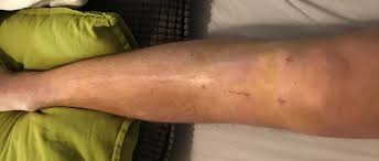 Finde Heraus Ob Dein Bluterguss Nach Knie Op Harmlos Ist Oder Nicht Knie Marathon Knie Op Reha Patienten Aufgepasst