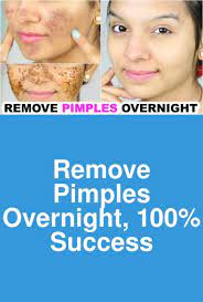 Remove Pimples Overnight 100 Success Pimples Are Small Skin Lesions Or Inflammations Of The Remove Pimples Overnight How To Remove Pimples Pimples Overnight