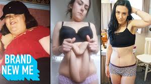 Undergoing the gastric bypass is a major decision that can potentially change your life forever. I Lost 140lbs And Finally Had My Extreme Excess Skin Removed Brand New Me Youtube