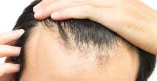 Daily hairstyles for reducing reclining hairline female ~ two strand twists with extensions. Receding Hairline Treatment Stages And Causes