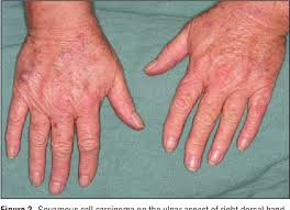 Breast cancer is the second most common cancer found in women — after skin cancer — but that doesn't mean men aren't at risk as well. Pdf Occurrence Of Nonmelanoma Skin Cancers On The Hands After Uv Nail Light Exposure Semantic Scholar