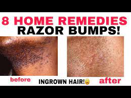 However, know that waxing can lead to histamine reactions and ingrown hairs, too—so take. 8 Home Remedies To Stop Ingrown Hairs Or Razor Bumps Aloe Vera Honey Baking Soda D N Medical Series Youtube