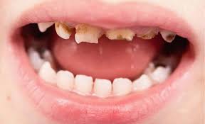 How to disinfect retainer reddit. 7 Common Dental Problems In Children