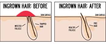 Stop any hair removal methods, at least in the area surrounding the ingrown hair 4. How To Get Rid Of Ingrown Hair