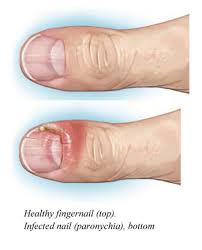 Image result for paronychium