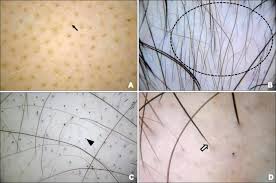 One of the most important structures is the dermal papilla. Dermoscopic Features Of Alopecia Areata Yellow Dots A Arrow Download Scientific Diagram