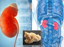Calcium oxalate, uric acid, struvite. How To Get Rid Of Kidney Stones What Causes Them And What To Eat To Prevent Them Mirror Online