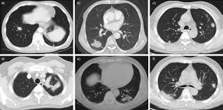 In april i developed a feeling of one side of my chest rattling, the doctor took an xray and diagnosed mild pneumonia in a negative ct scan would make lung disease and cancer less likely. Clinical Analysis Of 76 Patients Pathologically Diagnosed With Pulmonary Cryptococcosis European Respiratory Society