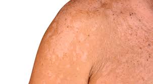 كيفية علاج التينيا الملونة ويب طب