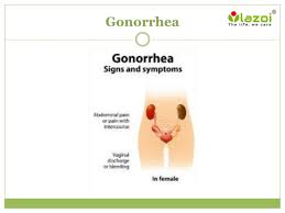 Image result for gonorrhea symptoms