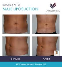 Image result for Liposuction