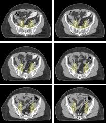 We did not find results for: Https Nanopdf Com Download An Atlas Of The Pelvic Lymph Node Regions To Aid Radiotherapy Pdf