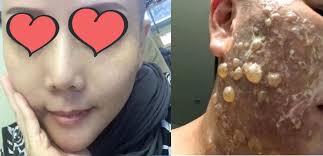 A Taiwanese plastic surgeon performs Thermage, which is an FDA approved,  well known and expensive facelift treatment. So what could have gone wrong?  https://www.thesun.co.uk/news/8919577/botched-facelift-blisters-burned-inside-out/  In a world where so ...