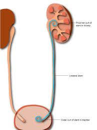 Ureteral Catheter Google Search Kidney Stones Kidney Medical Wallpaper