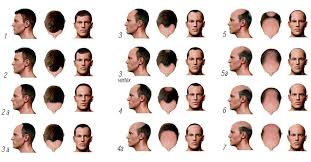 A receding hairline is a common type of baldness, often caused by androgenetic alopecia. 10 Best Haircuts And Hairstyles For Balding Men Too Manly