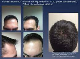 Corticosteroids work by decreasing inflammation. Prp For Hair Loss Chicago Pain And Wellness Institute