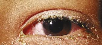  Is pink eye contagious by air before symptoms are present
