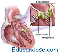 La miocarditis puede deberse también a otros agentes infecciosos de origen no viral, como ocurre en la enfermedad de lyme o la enfermedad de chagas, y a fármacos y otros tóxicos. Endocarditis Bacteriana Medicina Veterinaria Practica Facebook