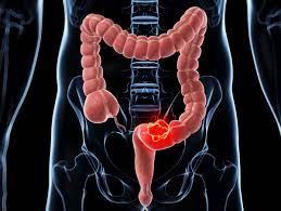 Gu?rison du cancer du colon. Cancer Colorectal Cancers Du Colon Et Du Rectum Symptomes Et Traitement Doctissimo