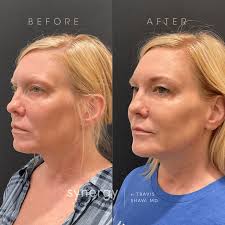 Juvéderm Facial Fillers