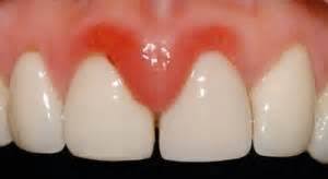 Gusi bengkak tidak hanya dapat menimbulkan ketidaknyaman pada mulut, tapi juga kerusakan pada jaringan dan tulang yang menopang gigi jika diabaikan. Gusi Bengkak Antara Penyebab Gusi Rohaya Dental Surgery Facebook