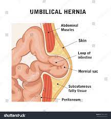 Umbilical Hernia 库存插图526917955 | Shutterstock