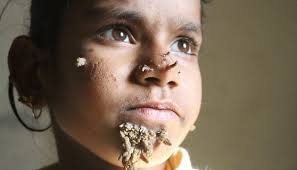 Epidermodysplasia verruciformis (ev) tree man syndrome by abi harris epidermodysplasia verruciformis works cited. Bangladeshi Girl May Be First With Female Tree Man Syndrome Newshub