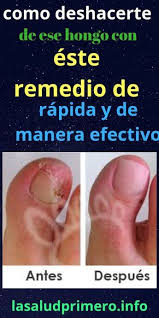 Remedios caseros hongo uña pie dedo gordo. 17 Ideas De Para Curar Hongos Hongos Remedio Para Hongos Eliminar Hongos