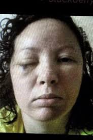 Mum-of-two discovered golf ball-sized tumour behind her eye