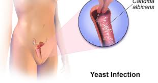 Yeast is a fungus normally found on your skin. Women With Diabetes At Risk For Recurrent Yeast Infections Phillyvoice